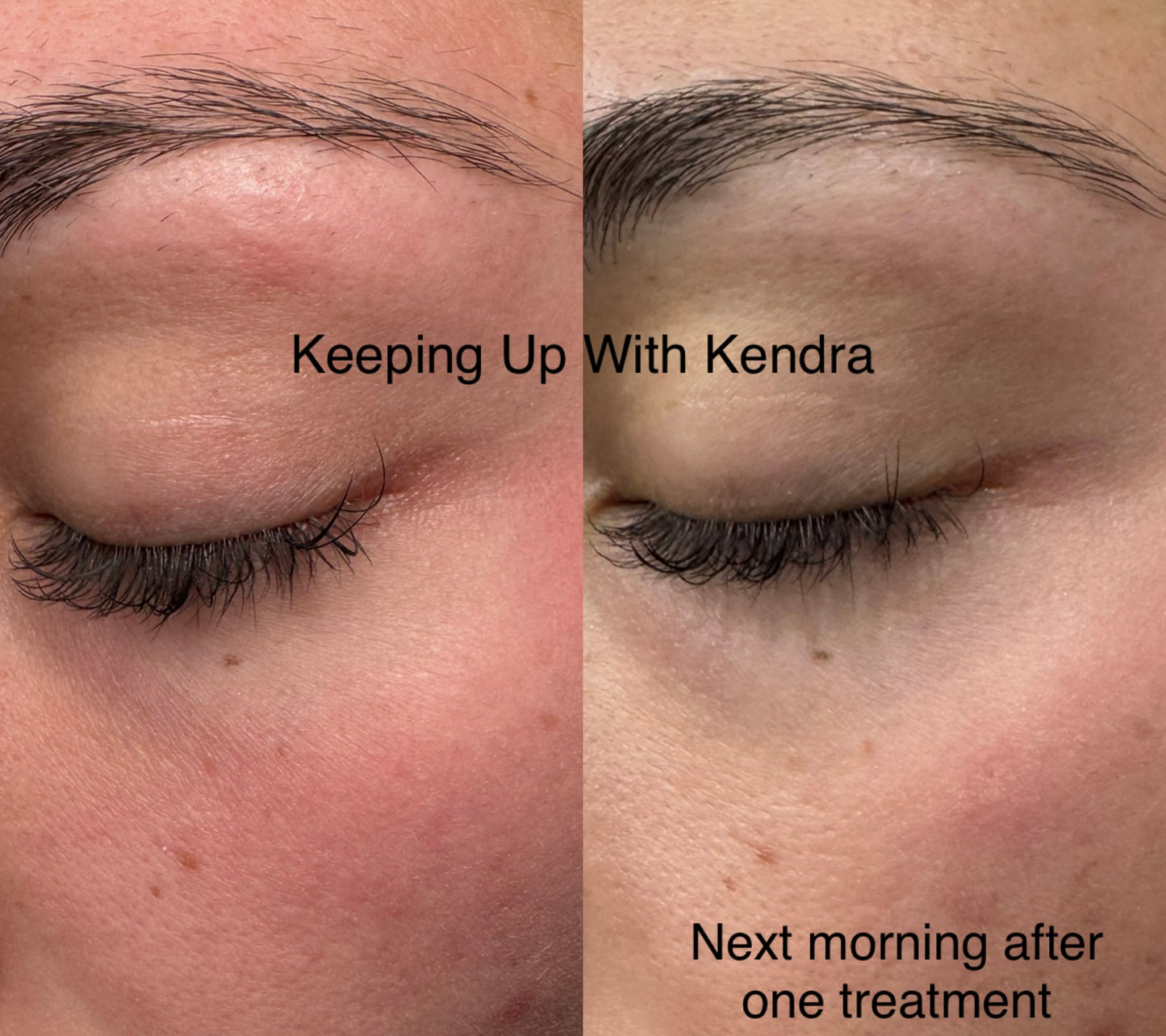 Micro-needle device bundle 💜