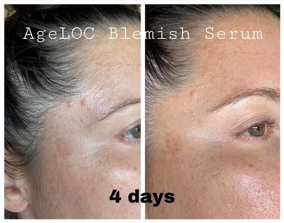 Blemish Serum