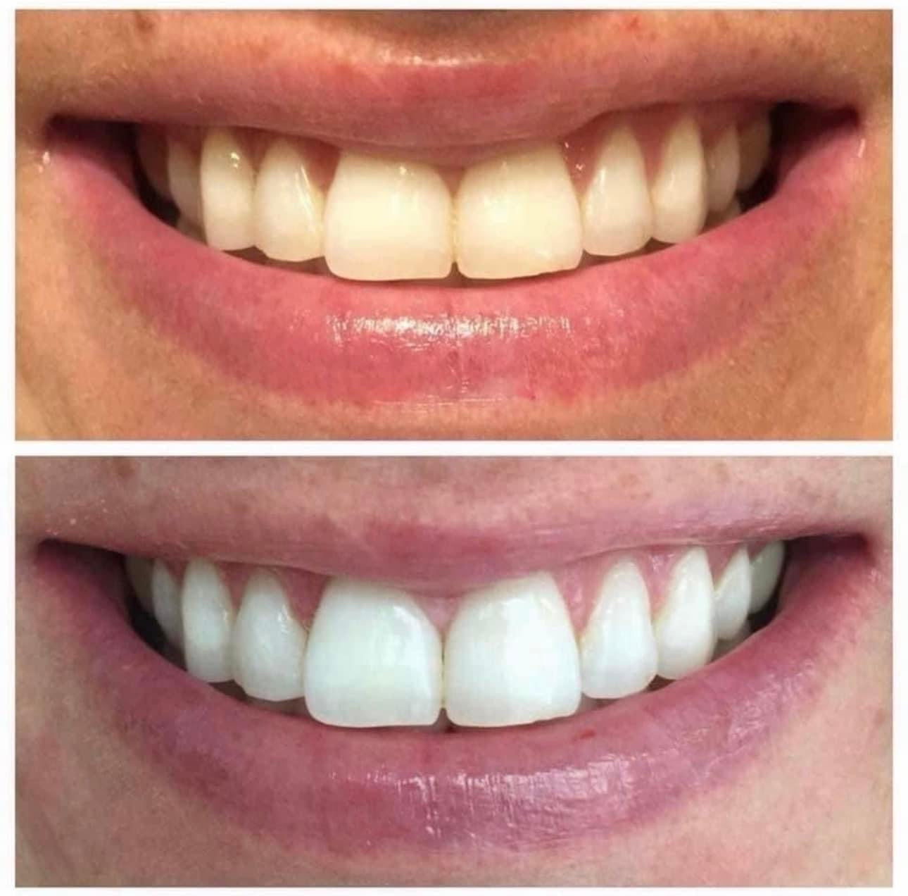 Whitening Toothpaste