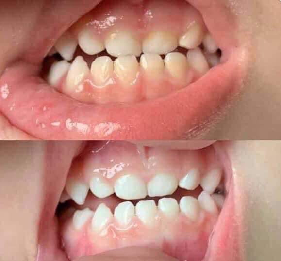 Whitening Toothpaste