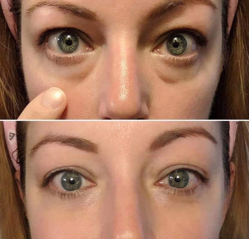 Eye attachment & eye cream